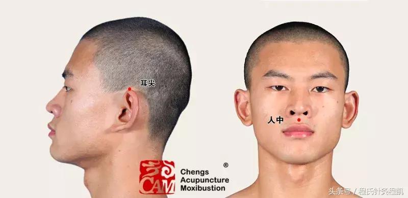 高温来袭,中暑急救快学掐人中