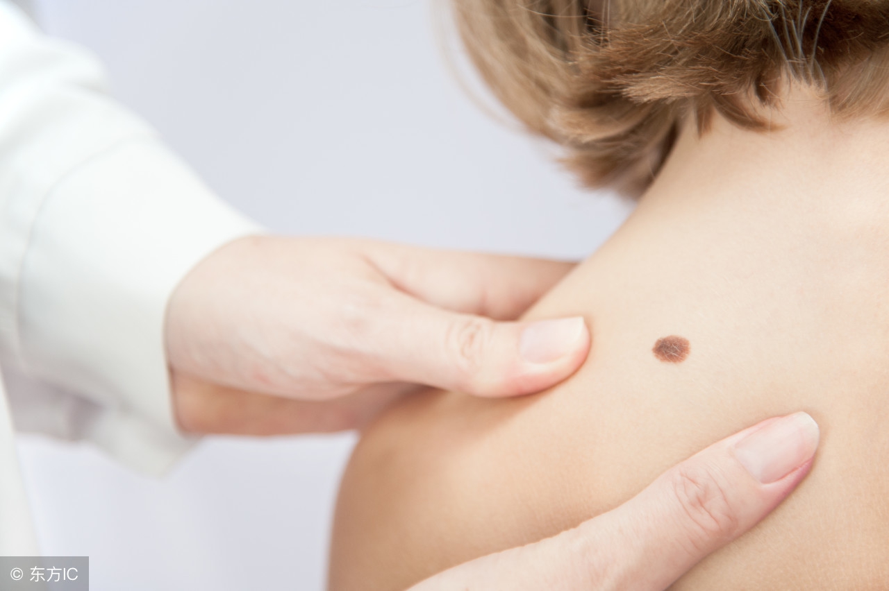 痣不能乱抠,痣用手抠掉后通常会留疤吗