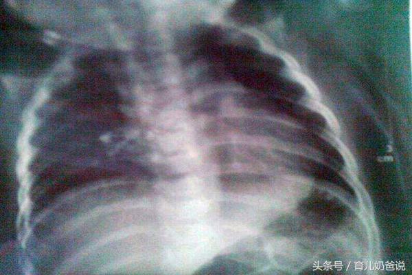 宝宝拍片说是肺炎有必要打点滴吗,肺炎拍ct婴儿不配合怎么办
