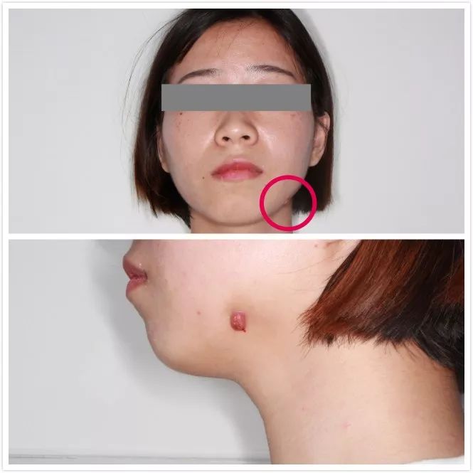 战痘多年才知道的真相,战痘多年不见效果