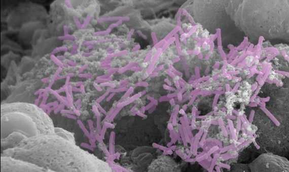 霉菌会导致宫颈癌吗,宫颈癌有没有基因突变导致的