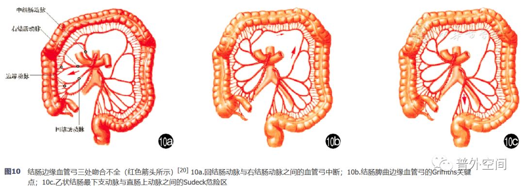 腹腔镜完整结肠系膜切除术相关血管变异与术中出血的应对措施(上)