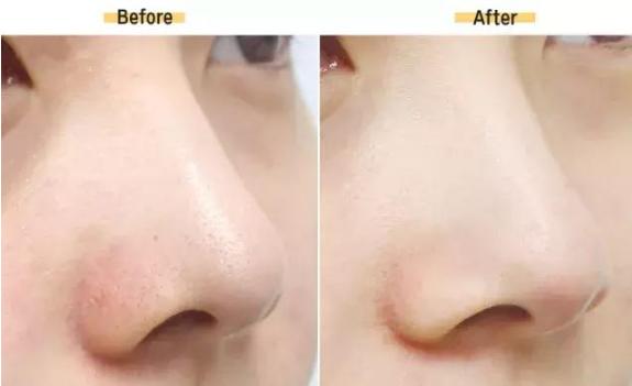 去黑头缩毛孔要看什么护肤成分,去黑头闭口护肤推荐