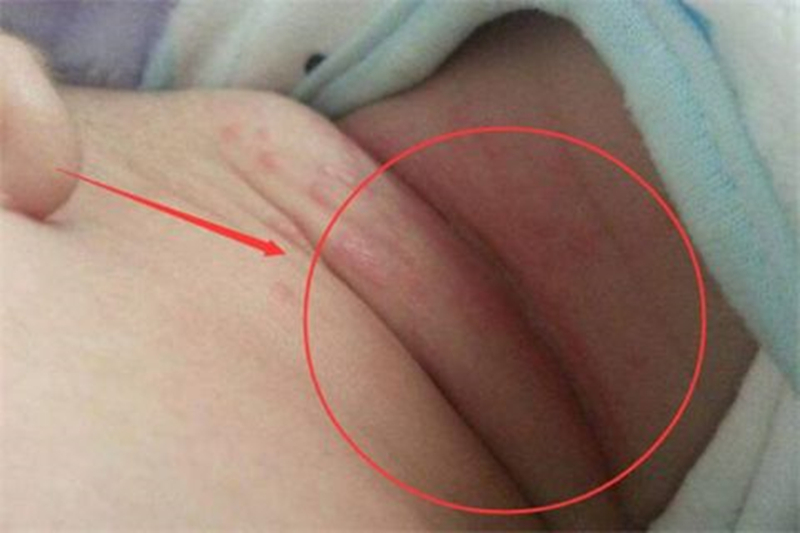 宝宝淹脖子怎么用香油,宝宝淹脖子护理