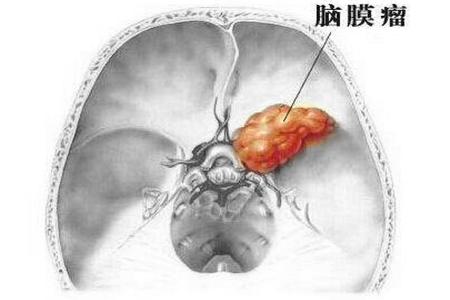 脑膜瘤手术后遗症有哪些,脑膜瘤手术后脑水肿有什么症状