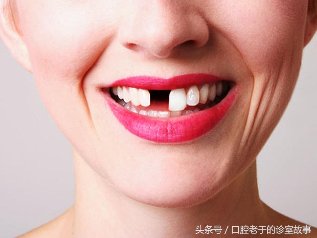 22岁缺一颗镶牙还是种植牙好,牙掉了是搭桥好还是种植牙好
