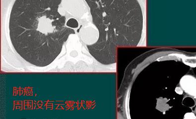 肺部3厘米的肿块是肺癌早期吗,肺上长出30cm肿块应该怎么办
