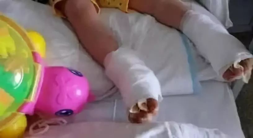 儿童玩耍金属滑梯被烫伤怎么处理,孩子玩滑滑梯屁股被烫伤