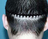 种植头发贵吗大概多少钱,种植头发的价格靠谱吗