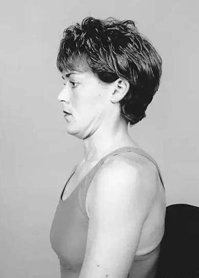 颈椎病麦肯基疗法基本动作,颈椎病的麦肯锡疗法