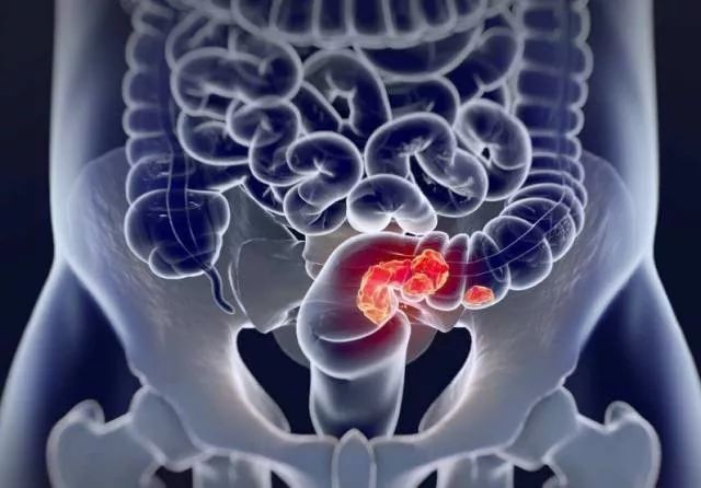 便血是什么原因引起的怎么治,什么是便血且血与粪便混合