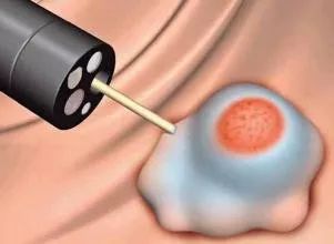 什么是便血喷射状,怎样区分直肠癌便血还是痔疮便血