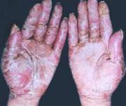 维生素缺乏神经性皮炎,治疗口腔溃疡脚气病的维生素