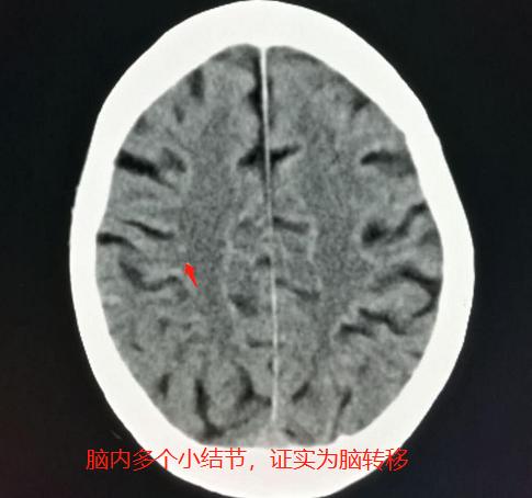 肺癌脑部转移还有脑血栓,脑梗查出肺结节怀疑肺癌