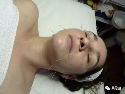 哈里梅根婚前求助中医！歪果仁已经把针灸吹上了天