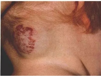 宝宝出生有青色胎记是怎么回事,宝宝出生有绿色胎记怎么办