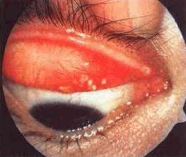 眼结石走进科学,眼结石最快排出方法