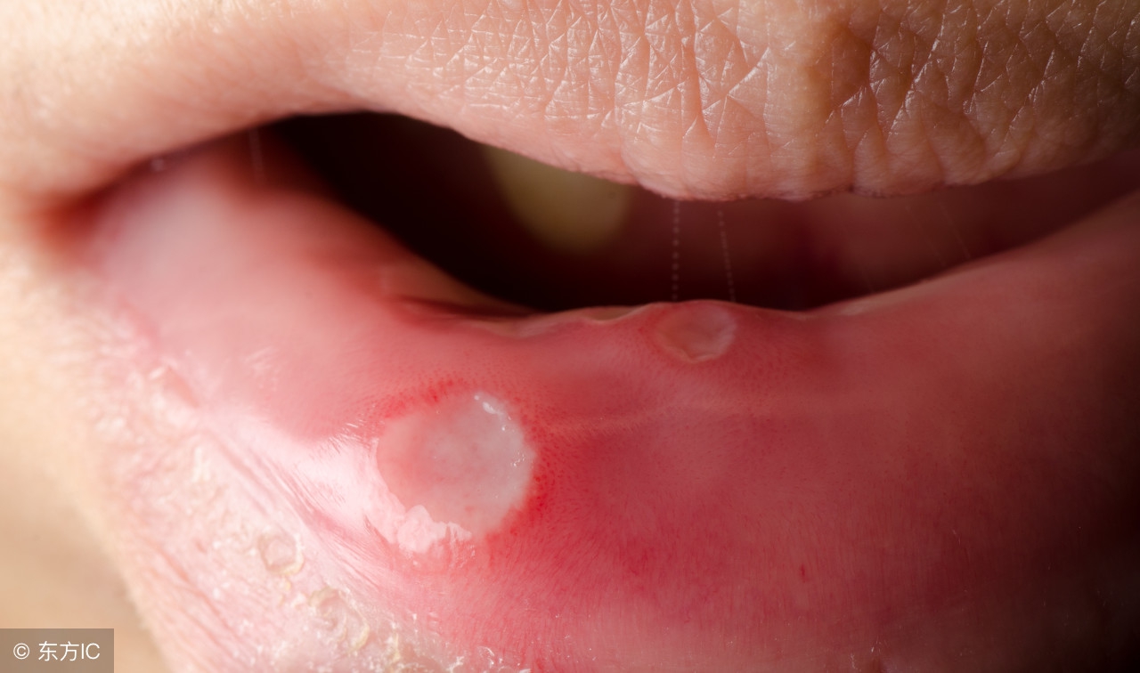 hiv感染早期症状一般几个月出现,hiv和梅毒同时感染有什么症状