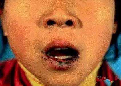 嘴唇上有黑斑是有癌症了吗,嘴唇有黑斑是肠道有病吗