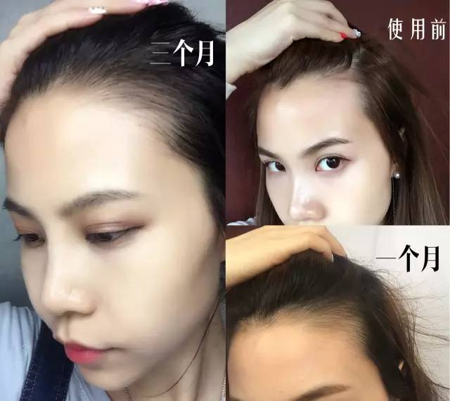脱发、发际线高、地中海的克星！用它，1个月头发不掉了，不痒了，半年变浓密