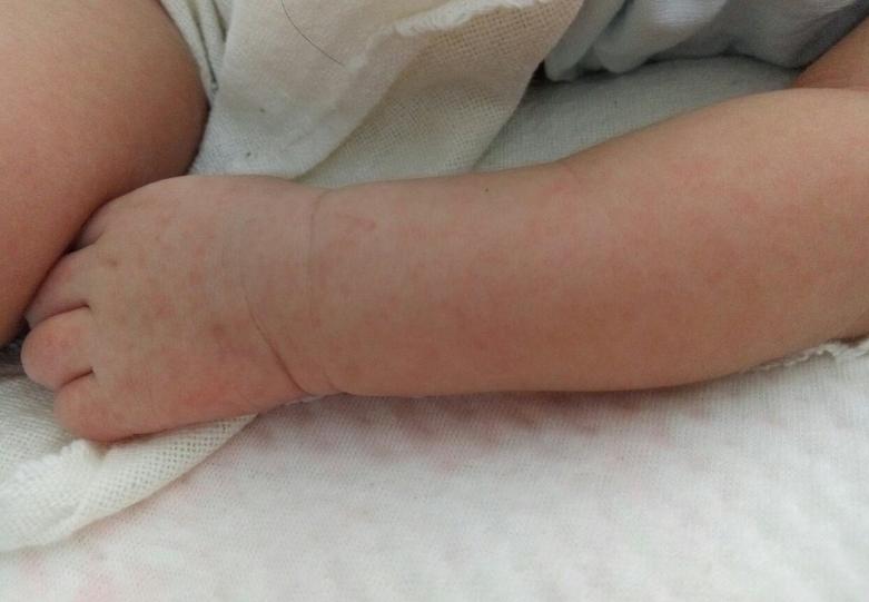 宝宝起痱子了怎么快速消除,小儿长痱子的最快治疗方法