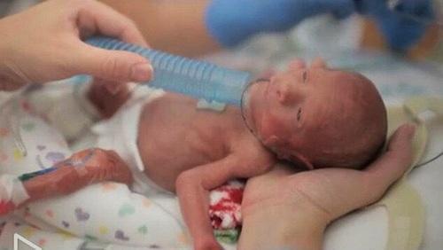 早产宝宝肠绞痛症状表现及护理,孩子早产怎么安慰爸爸妈妈