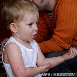 宝宝湿疹怎么消除又快又好土方法,夏季宝宝湿疹的最佳治疗方法