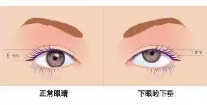 眼皮不对称是什么意思,眼皮不对称一只斜一点