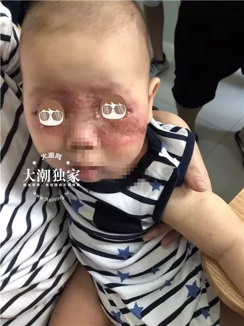 隐翅虫的图片和它的危害,隐翅虫严重后果图片