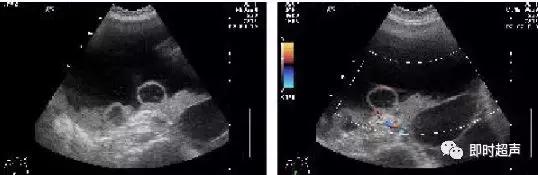 卵巢畸胎瘤的超声声像诊断,超声能不能看到卵巢畸胎瘤内部
