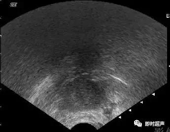 卵巢畸胎瘤的超声声像诊断,超声能不能看到卵巢畸胎瘤内部