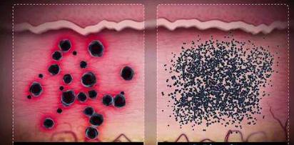 皮秒和超皮秒哪个祛斑效果好些,皮秒祛斑视频疼吗