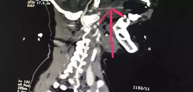 揪心！13厘米竹签插入两岁娃嘴里生命垂危！做家长的千万要注意！