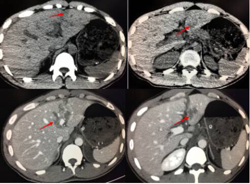 不可思议，22岁的小年轻，转呼啦圈转到脾破裂！