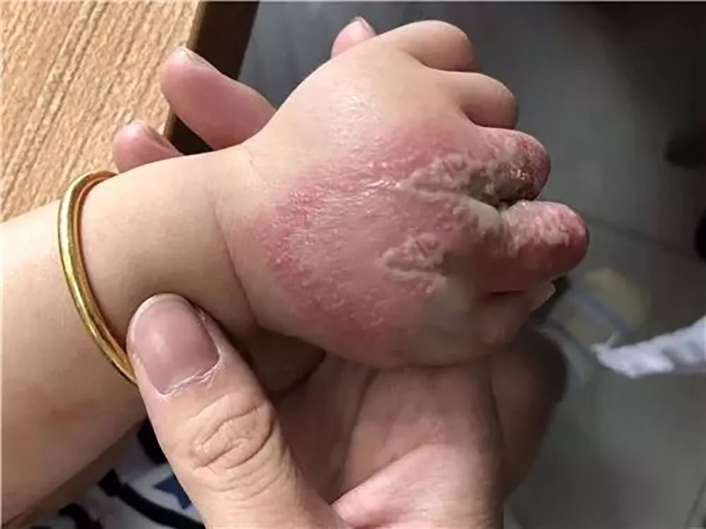 十几个月大的孩子因为它几乎毁容，夏天这两种虫要警惕……