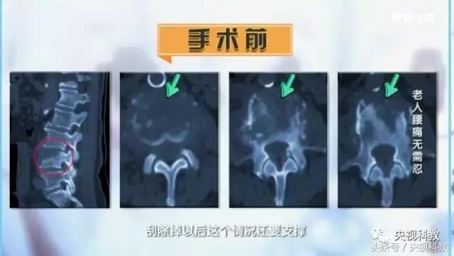 健康之路|82岁高龄腰病患者,这样治疗后身体恢复如初!