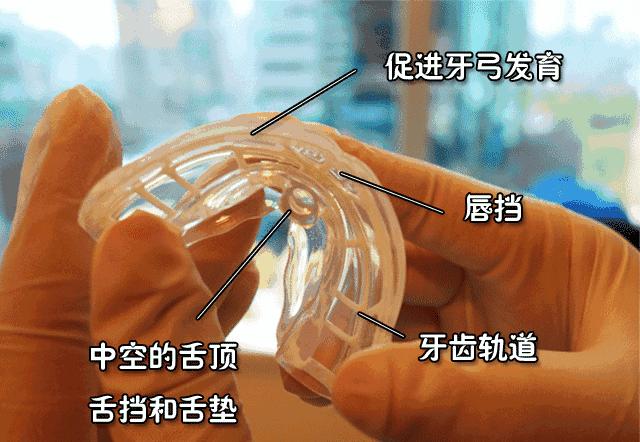 孩子口腔系带有什么危害,儿童上唇系带连接牙龈有什么影响