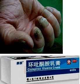 治疗真菌感染含有激素的药膏,中药治皮肤真菌感染药膏排名