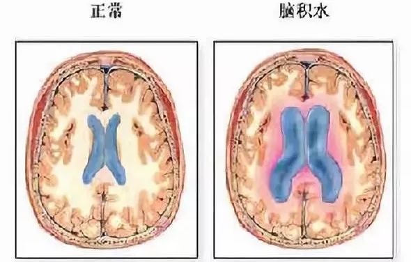 高反怎么化解,高反怎么办教你一招解决