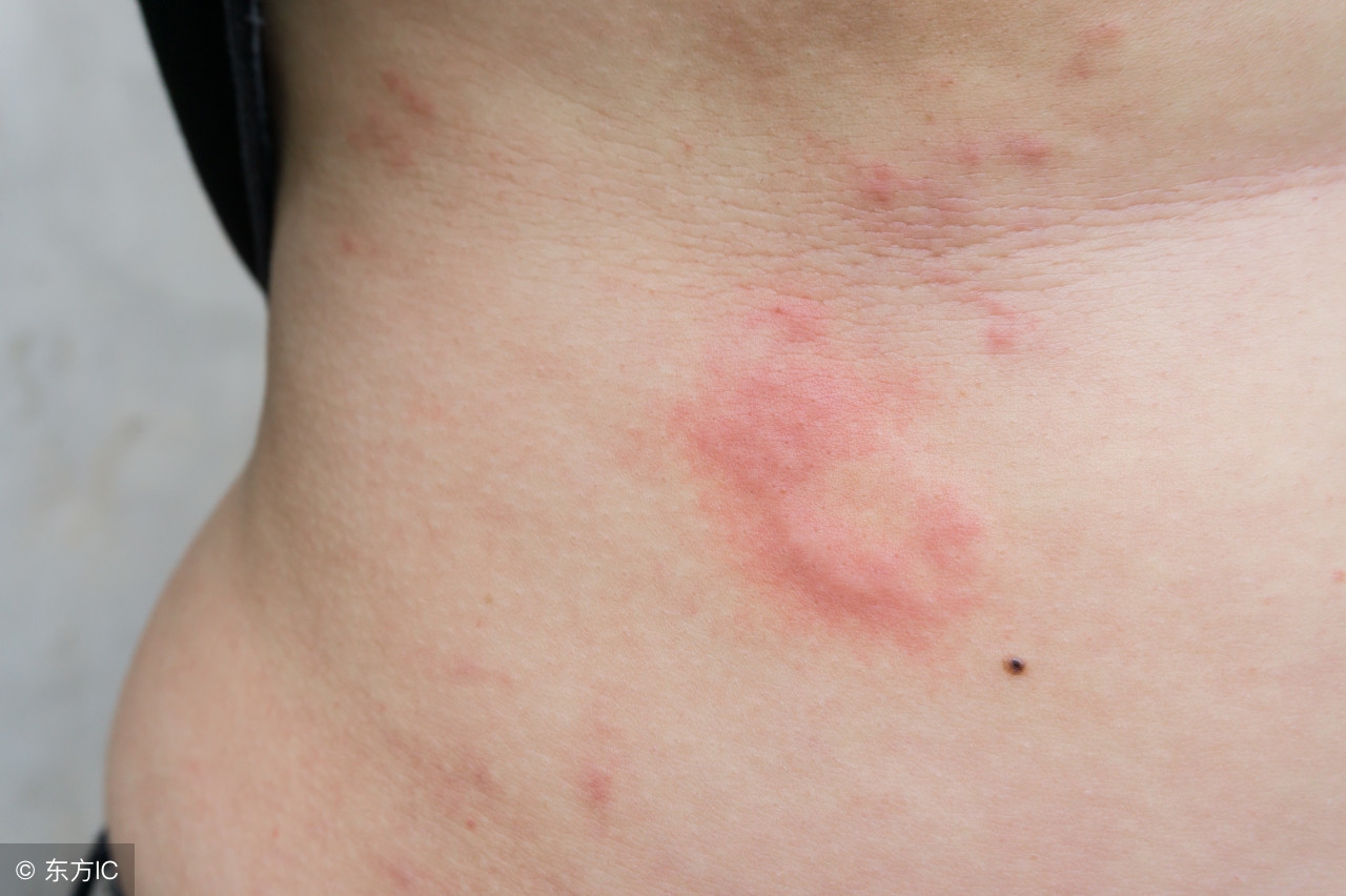 麻疹和荨麻疹有关系吗,麻疹对身体有什么坏处