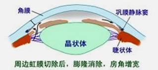 上了散瞳药还能上降眼压的药吗,降眼压副作用小的药水推荐