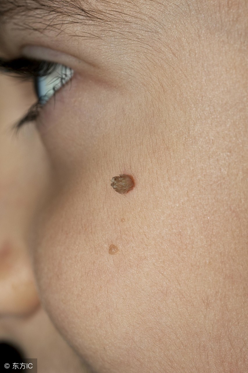 怎样预防寻常疣传染给孩子,怎样预防寻常疣的发生