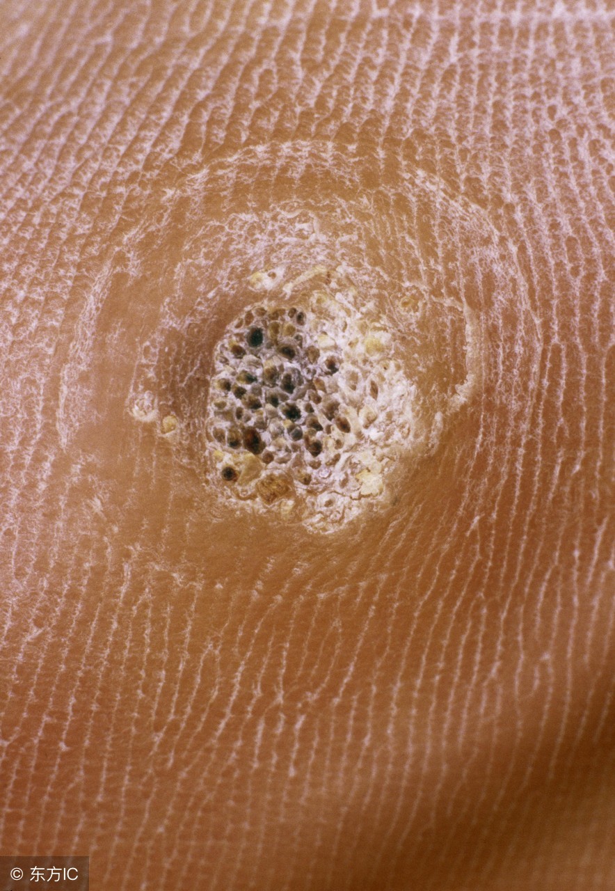 怎样预防寻常疣传染给孩子,怎样预防寻常疣的发生