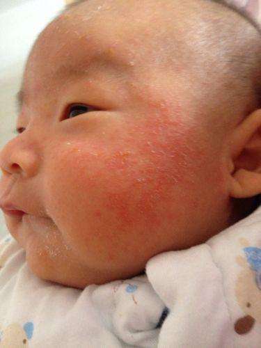 治疗宝宝湿疹比较好的药膏,治疗宝宝湿疹最好的中医院