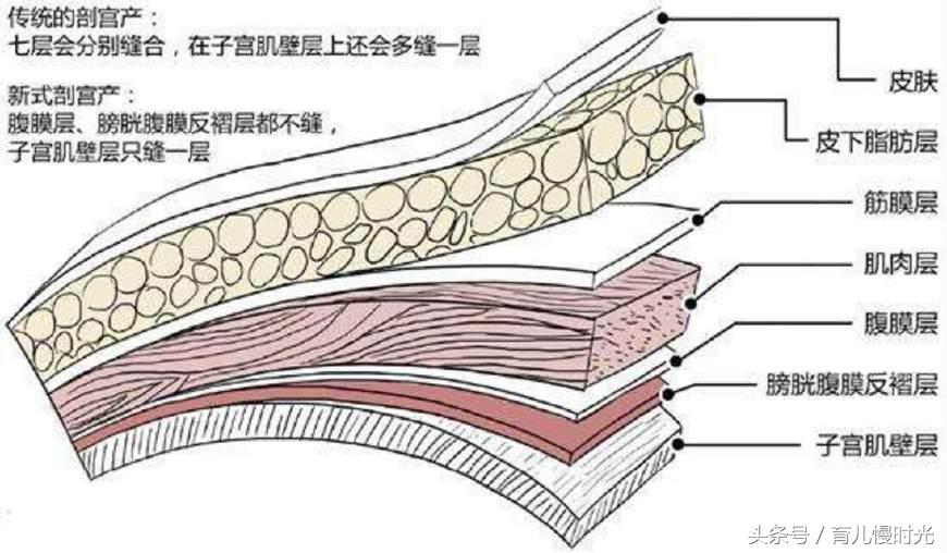 剖腹产伤口脂肪液化和化脓的区别,剖腹产脂肪液化是因为太热了吗