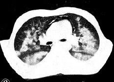 蝶翼征是间质性肺水肿的表现吗,肺蝶翼征