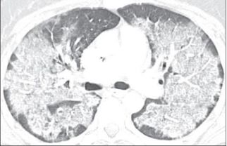 肺水肿和左心衰如何鉴别诊断,蝶翼征