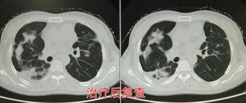 癌症靶向药治疗一年费用是多少,免疫加靶向治疗癌症几次能见效