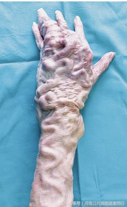 静脉曲张郑大一附院看哪个科,郑大一附院硬化剂治疗静脉曲张