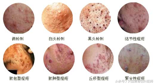 疮痈治疗,痘疮中药怎么治